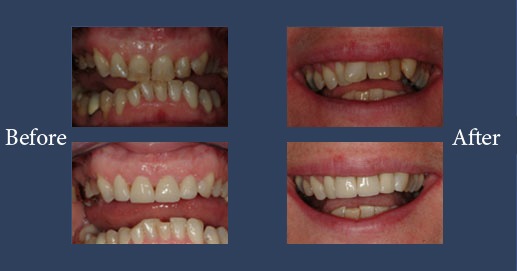 Lumineers veneers