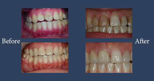 Lumineers veneers