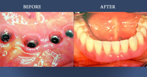 Rehabilitation on implants