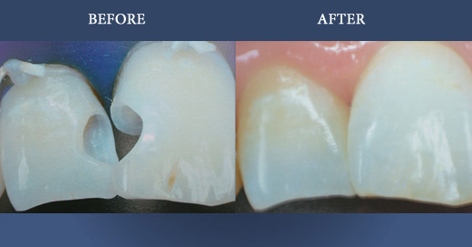 Cosmetic composite filling