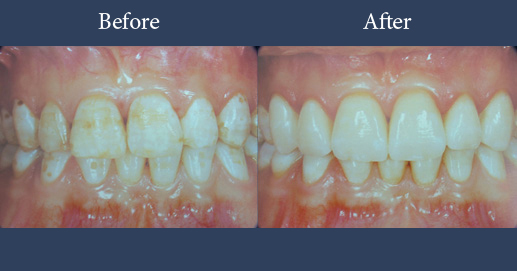 Cosmetic dentistry