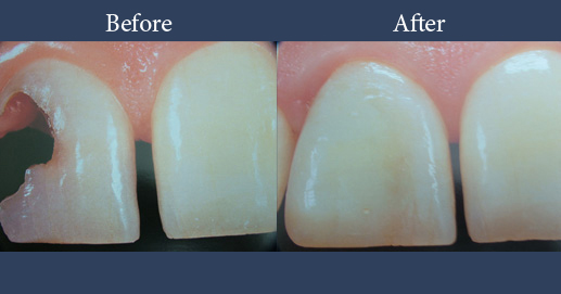 Cosmetic composite restoration