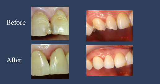 Cosmetic composite restoration