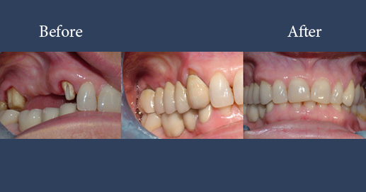 Gold-ceramic fixed bridge