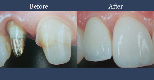 Gold stump pin and ceramic capsule