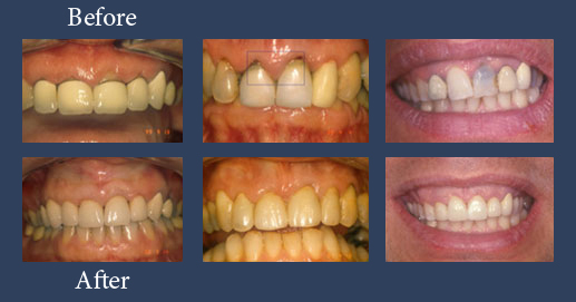 Example of prosthetic rehabilitations