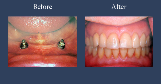 Removable dentures on bar and ball implants for retention 