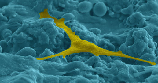 Odontoiatria - Immagine elemento estraneo su impianto dentale non perfettamente pulito