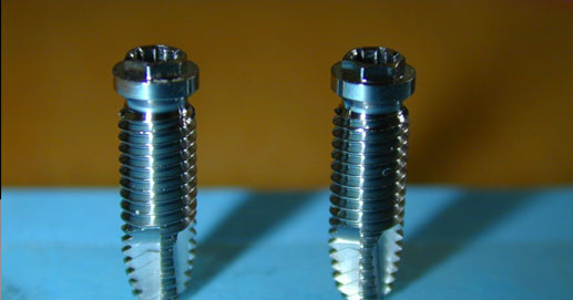 Odontoiatria - Impianto in titanio ad esagono esterno