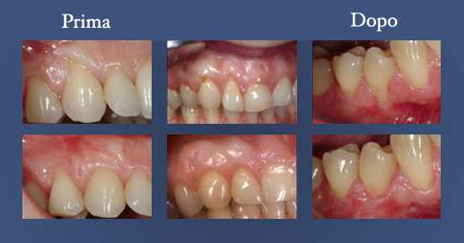 Odontoiatria Estetica - Risoluzione di alcuni casi di regressione gengivale