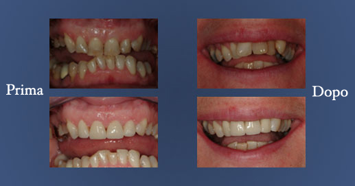 Odontoiatria Estetica - Faccetta Lumineers