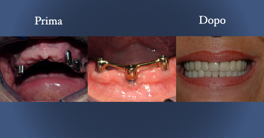 Odontoiatria - Protesi mobile sup. inf. supportata da impianti dentali
