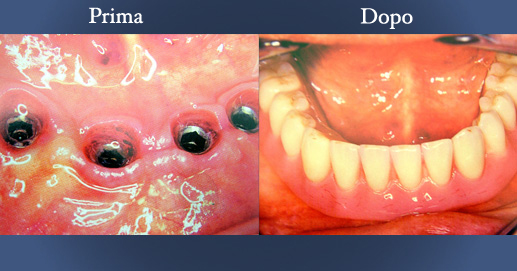 Odontoiatria - Riabilitazione su impianti