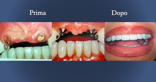 Odontoiatria - Riabilitazione su impianti