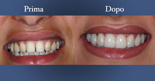 Odontoiatria Estetica - Faccetta Lumineers
