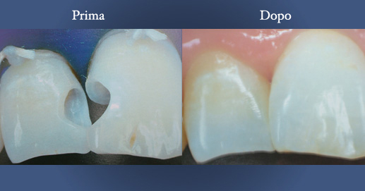 Odontoiatria Estetica - Otturazione etetica in composito