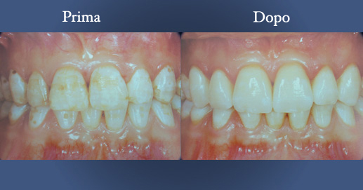 Odontoiatria Estetica - Cosmesi Odontoiatrica