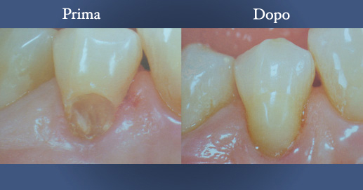 Odontoiatria Estetica - Otturazione etetica in composito