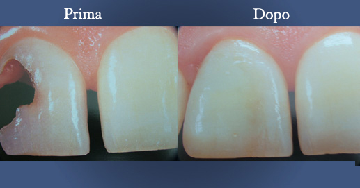 Odontoiatria Estetica - Ricostruzione etetica in composito