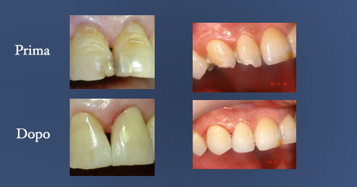 Odontoiatria Estetica - Ricostruzione etetica in composito