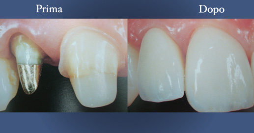 Odontoiatria - Perno moncone in oro e capsula in ceramica