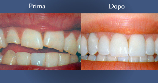 Odontoiatria - Ricostruzine estetiche dopo fratture multiple