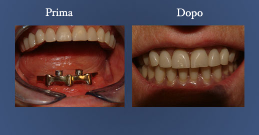 Odontoiatria - Protesi rimuovibile su impianti con barra e sfere per la ritenzione