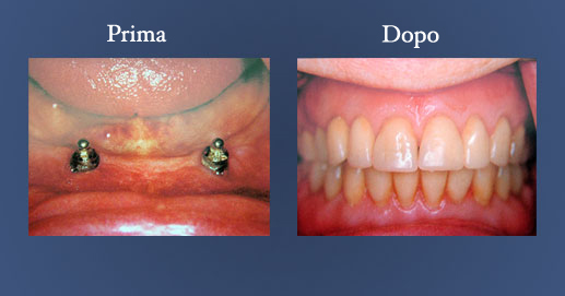 Odontoiatria - Protesi rimuovibile su impianti con barra e sfere per la ritenzione