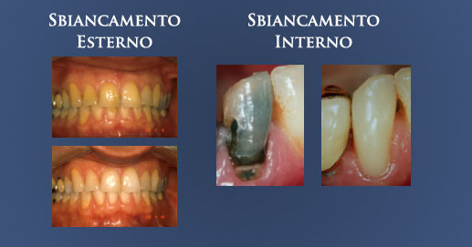 Odontoiatria Estetica - Vari momenti dello sbiancamento dentale