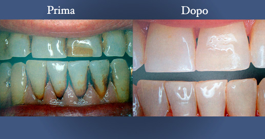 Odontoiatria Estetica - Vari momenti dello sbiancamento dentale