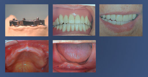 Odontoiatria - Protesi rimuovibile su impianti con barra e sfere per la ritenzione