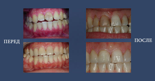 Грани Lumineers