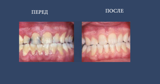Гигиена полости рта и эстетические пломбы из композитных материалов