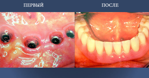 Восстановление имплантатов