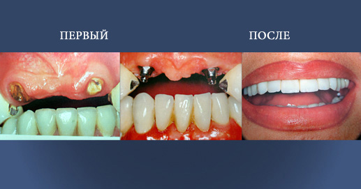 Восстановление имплантатов