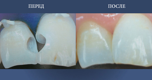 Эстетическая пломба с композитных материалов