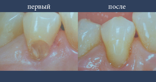 Эстетическая пломба с композитных материалов