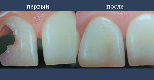 Эстетическая реконструкция с композитных материалов