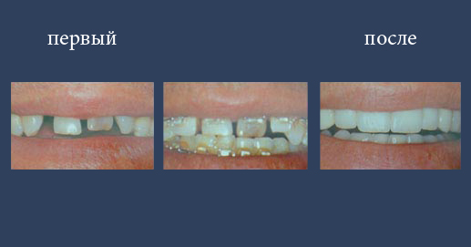 Ортодонтическая необходимость выравнивания граней