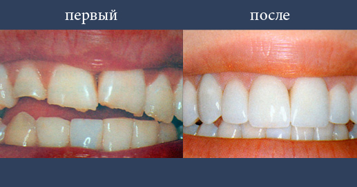 Эстетическая реконструкция после множественных повреждений