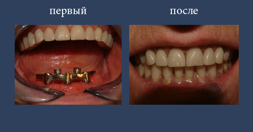 Съемный протез на имплантатах со стержнем и шариками для фиксации