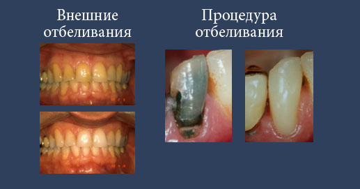  Различная степень отбеливания зубов