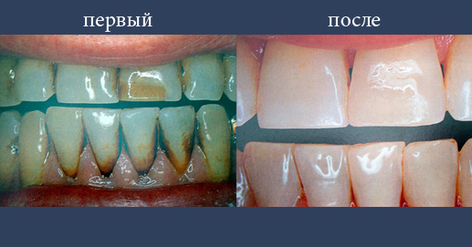  Различная степень отбеливания зубов