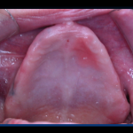 impiantologia odontoiatria tradizionale - impianto iuxtaosseo