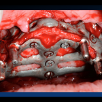 impiantologia odontoiatria tradizionale - impianto iuxtaosseo