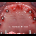 impiantologia odontoiatria tradizionale - impianto iuxtaosseo