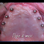 impiantologia odontoiatria tradizionale - impianto iuxtaosseo