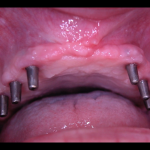 impiantologia odontoiatria tradizionale - impianto iuxtaosseo