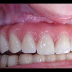 impiantologia odontoiatria tradizionale - impianto iuxtaosseo