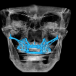 impiantologia odontoiatria tradizionale - impianto iuxtaosseo